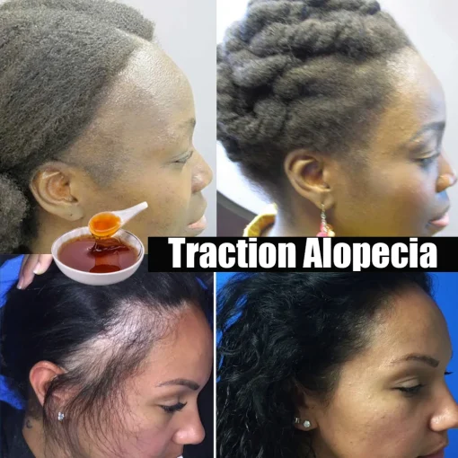 Cabello africano Alopecia por tracción Crecimiento